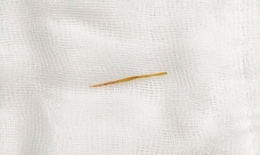 Thủng ruột do thói quen rất nhiều người mắc