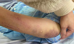 Nữ sinh lớp 7 ở Nghệ An nghi bị bố đánh bầm tím khắp người