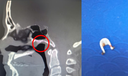 Người đàn ông chịu đau đầu suốt 40 năm vì dị vật ‘bỏ quên’ sâu trong mũi 