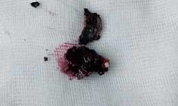 Bác sĩ lấy dị vật vôi hóa tồn tại nhiều năm trong mũi bệnh nhân