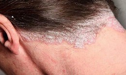 Nấm da đầu có gây rụng tóc không?