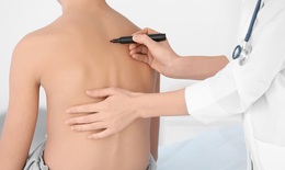 L&#224;m g&#236; khi trẻ g&#249; lưng, cong vẹo cột sống do d&#249;ng điện thoại qu&#225; nhiều?