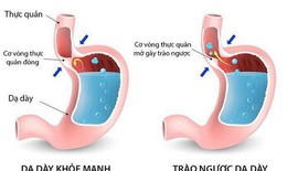 Những việc nên và không nên làm khi mắc trào ngược dạ dày 