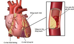 5 biện ph&#225;p giảm nguy cơ biến cố tim mạch khi thời tiết lạnh
