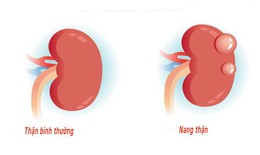 Nang thận có thật sự lành tính? Chuyên gia cảnh báo những dấu hiệu tuyệt đối không được bỏ qua