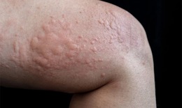 Nguy&#234;n nh&#226;n nổi mề đay thường gặp g&#226;y ngứa ng&#225;y, kh&#243; chịu