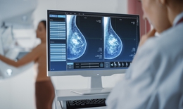 Ai nên chụp nhũ ảnh thường xuyên để phát hiện sớm ung thư vú?