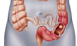 Đau bụng, đầy hơi… cảnh giác với viêm túi thừa manh tràng