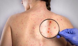 Thai nhi bị ảnh hưởng thế nào nếu người mẹ nhiễm rubella?