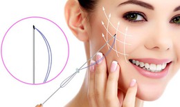 Cấy chỉ thẩm mỹ giúp làm đẹp da như thế nào?