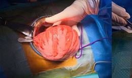 Người đàn ông 'chửa phân' do mắc căn bệnh bẩm sinh phức tạp