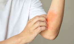 Dị ứng thức ăn làm sao để nhận biết?