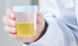 Màu sắc nước tiểu báo động tình trạng sức khỏe gặp rắc rối