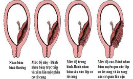Bác sĩ vượt 100km cứu sản phụ rau cài răng lược nguy kịch