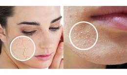 Cách khắc phục, chăm sóc da khô sần