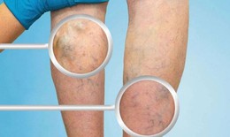 Viêm tắc tĩnh mạch chân có nguy hiểm không?