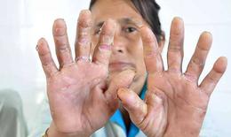 Các thuốc điều trị bệnh á sừng