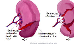 Bài tập tốt cho người sau chấn thương lách