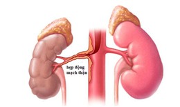 Hẹp động mạch thận: Nguy&#234;n nh&#226;n, biểu hiện, c&#225;ch điều trị v&#224; ph&#242;ng bệnh