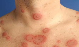 Hội chứng Evans: Nguy&#234;n nh&#226;n, biểu hiện, c&#225;ch điều trị v&#224; ph&#242;ng bệnh