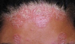 Thuốc nào trị bệnh vảy nến da đầu?