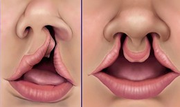 Hở hàm ếch: Nguyên nhân, biểu hiện, cách điều trị và phòng bệnh