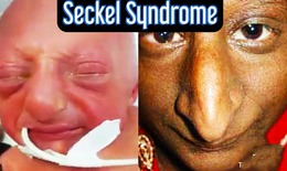 Hội chứng seckel: Nguyên nhân, biểu hiện, cách điều trị và phòng bệnh