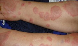 Hồng ban nút: Nguyên nhân, biểu hiện, cách điều trị và phòng bệnh