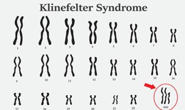 Hội chứng Klinefelter: Nguy&#234;n nh&#226;n, biểu hiện, c&#225;ch điều trị v&#224; ph&#242;ng bệnh