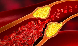Hẹp động mạch cảnh: Nguyên nhân, biểu hiện, cách điều trị và phòng bệnh