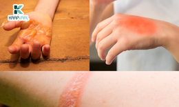 Khi sẹo sau bỏng không còn là nỗi lo