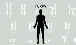 Hội chứng XYY: Nguyên nhân, biểu hiện, cách điều trị và phòng bệnh