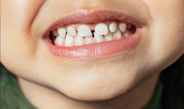 Top 3 sai lầm khi chăm sóc răng sữa ở trẻ