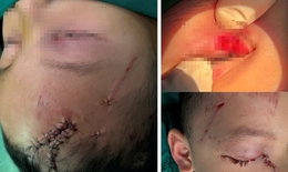 Cấp cứu trẻ bị chó cắn tổn thương nghiêm trọng vùng mặt
