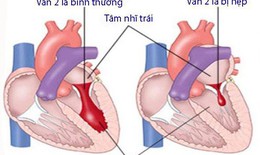 Hẹp van hai lá: Nguyên nhân, biểu hiện, cách điều trị và phòng bệnh