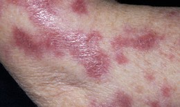 Thuốc điều trị bệnh lao da v&#224; m&#244; dưới da