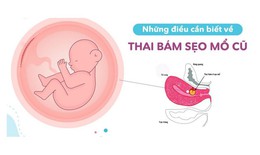 C&#226;u hỏi thường gặp li&#234;n quan đến bệnh chửa ở vết mổ