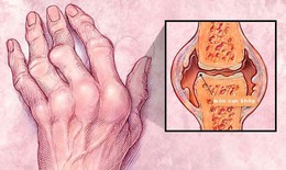 Hội chứng Felty: Nguyên nhân, biểu hiện, cách điều trị và phòng bệnh