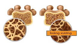 Những điều nên và không nên làm khi bị loãng xương