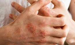 C&#226;u hỏi thường gặp li&#234;n quan đến dị ứng thời tiết