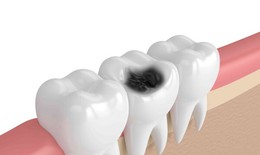 S&#226;u răng kh&#244;ng được chủ quan, c&#225;ch chữa thế n&#224;o?