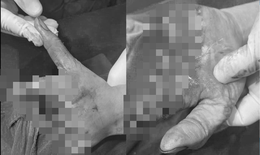 Bất cẩn trong lao động, bàn tay trái người phụ nữ bị cuốn vào máy nghiền