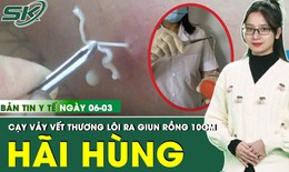Bản Tin Y Tế 6/3: Cạy vảy vết thương, người đàn ông hãi hùng lôi ra con giun rồng dài 10cm