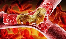 Triglyceride máu cao cũng làm tăng nguy cơ đột quỵ và bệnh tim
