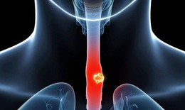 Loét thực quản: Nguyên nhân, biểu hiện, cách điều trị và phòng bệnh
