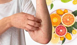10 lưu ý về chế độ dinh dưỡng cho bệnh sởi