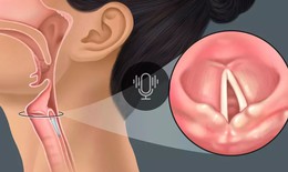 Chế độ ăn cho bệnh nhân liệt cơ mở thanh quản