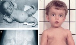 Loạn sản sụn xương: Nguyên nhân, biểu hiện, cách điều trị và phòng bệnh