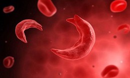 C&#226;u hỏi thường gặp li&#234;n quan đến bệnh hồng cầu lưỡi liềm