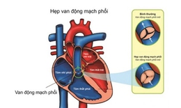 Câu hỏi thường gặp liên quan đến bệnh hẹp động mạch phổi